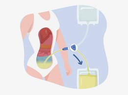 [Translate to Germany - German:] Peritoneal dialysis